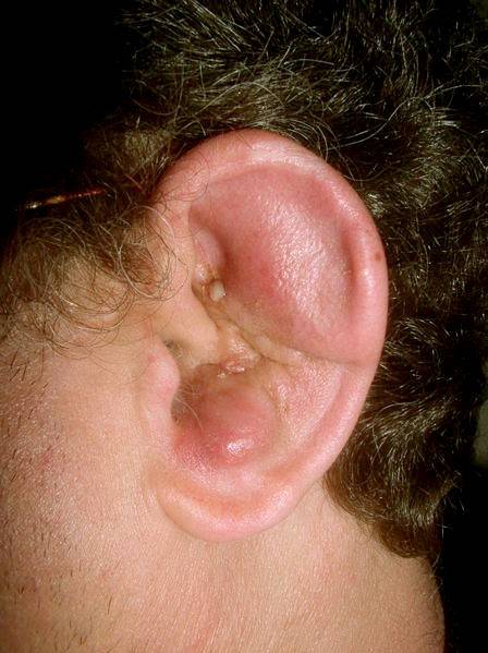 Perichondritis