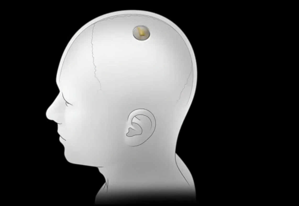 Oticon – Neuro Zti Cochlea-Implantat kommt wieder