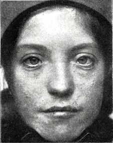 Patient with Waardenburg Klein syndrome 1916