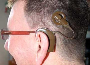 Ab wann brauche ich ein Cochlea Implantat?