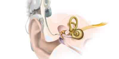 cochlear implantat grafik